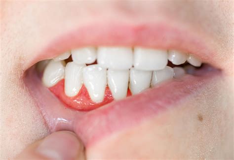 how to fix inflamed gums