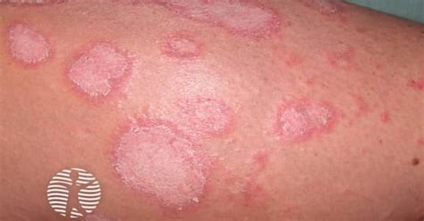erythema annulare centrifugum image