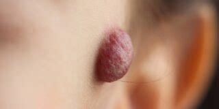 Angioma nel neonato: cause, rischi e trattamento | GOL