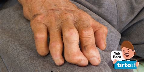 kemenkes waspadai sejumlah penyakit tropis  indonesia