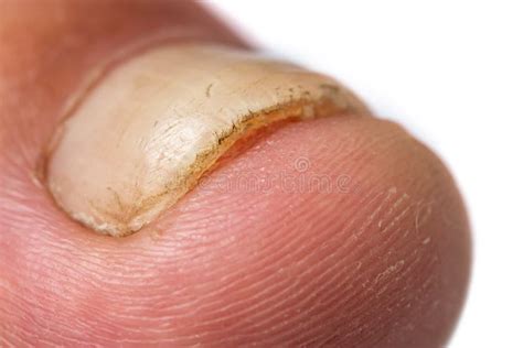 Toe Nail with Psoriasis and Healthy Toe Nails, Psoriatic Nail, Close-up ...