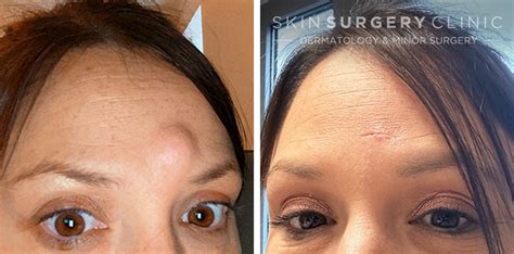 Cyst Removal in Leeds Bradford from £425 | Skin Surgery Clinic