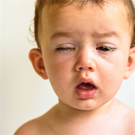 eye swelling toddler  jill baker blog