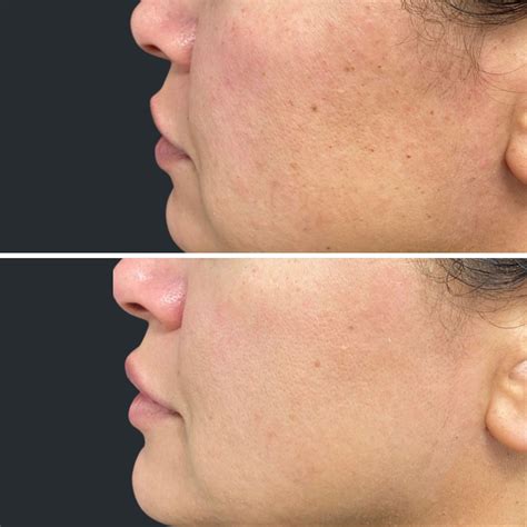 BBL Laser Brisbane | BBL Treatment - BBL Forever Young & BBL Facial