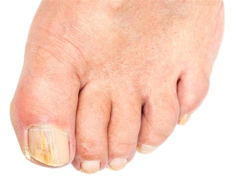 Manchas Blancas En Las Uñas De Los Pies - Banco de fotos e imágenes de ...