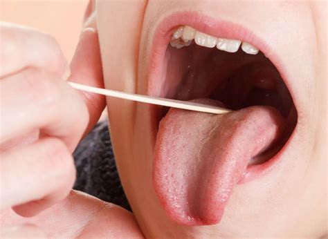 Amígdalas Inchadas O Que Pode Ser - Amígdalas Inchadas: o que pode ser e como tratar