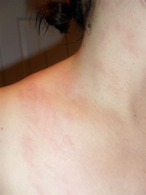 Skin rash celiac disease – Artofit