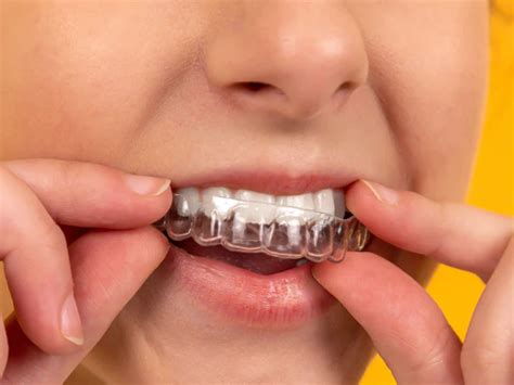 🦷Елайнери для зубів у Житомирі|Капа для вирівнювання зубів