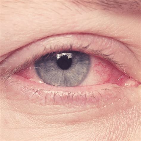 how to know what type of pink eye you have