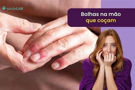 Bolhas Na Mao O Que Pode Ser - Bolhas na mão que coçam: desvendando a desidrose e seus tratamentos ...