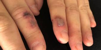 Disseminated Gonococcal Infection in an Immunosuppressed Patient - The ...