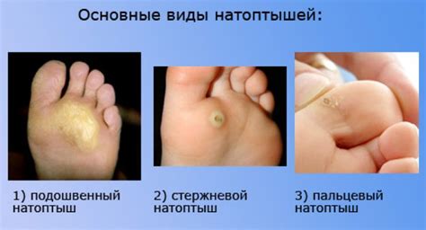Что такое натоптыши на ногах и как они выглядят, фото