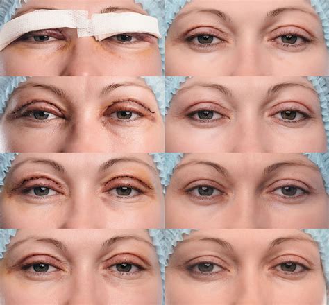Blefaroplastika | Skinite 10 godina s vašeg lica! Poliklinika Knezović