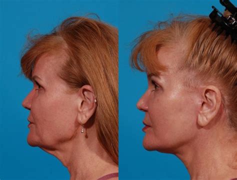 facelift    patient  tucson az foothills