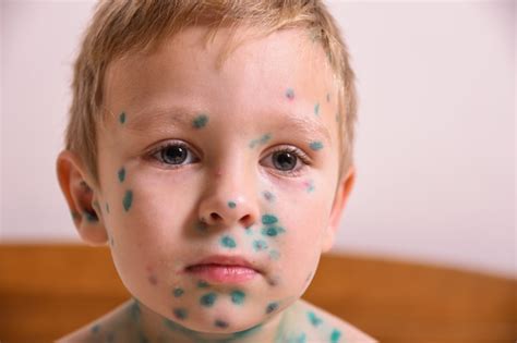 Jeune Enfant En Bas âge, Garçon Avec La Varicelle. Enfant Malade Avec ...