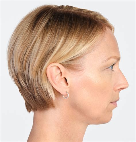 Radiesse | Before & After - Radiesse Injectables