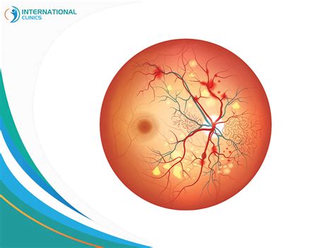 Vitreous Hemorrhage Treatment: New Updates 2024 | International Clinics