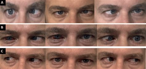 photographs   gaze primary position  left gaze  st