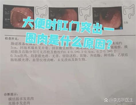 大便时肛门突出一圈肉是什么原因？