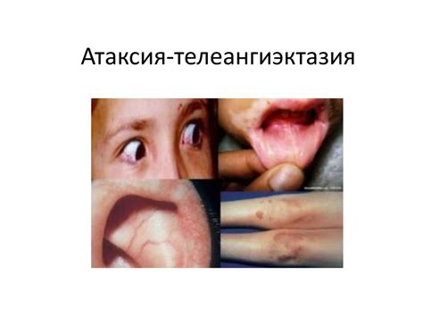 Атаксия-телеангиэктазия - презентация онлайн