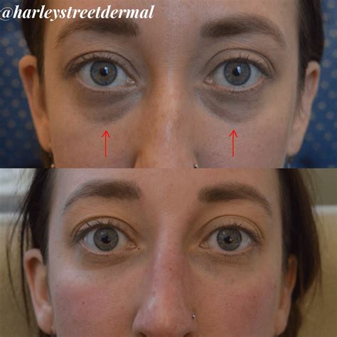Ipl Laser Dark Circles Under Eyes at Alyssa Coode blog