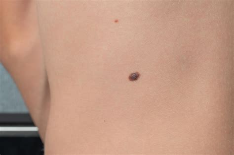 Brown warts on the child's body. 11771247 Stock Photo at Vecteezy