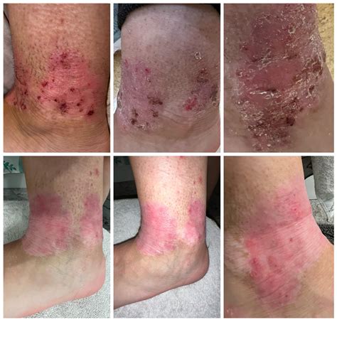 How to deal with eczema around mouth? : r/eczema
