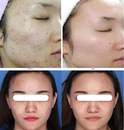 Red Light Therapy Before and After - Ashine LED Red Light Therapy ...