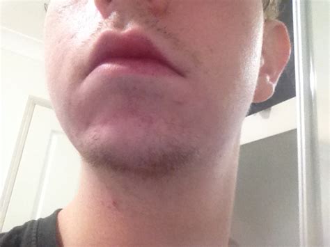 Do I Have Mild Or Moderate Acne – General acne discussion – Acne.org Forum