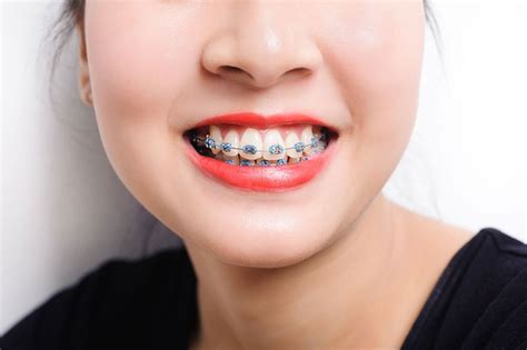 cost  braces  singapore