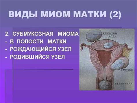 МИОМА МАТКИ Миома матки доброкачественная опухоль развивающаяся