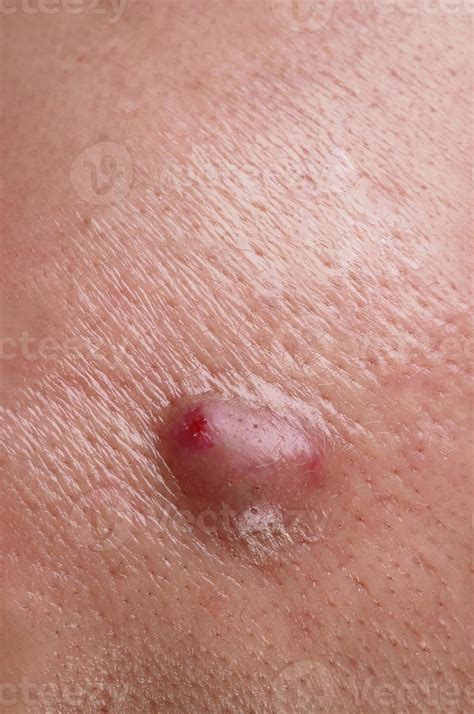 Bacterial skin infection. Big Acne Cyst Abscess or Ulcer Swollen area ...