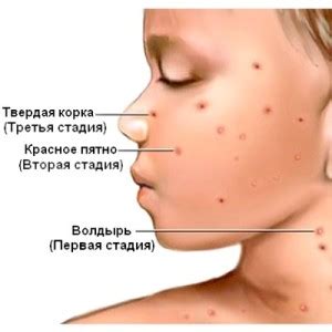 Шрамы после ветрянки: причины, способы устранения