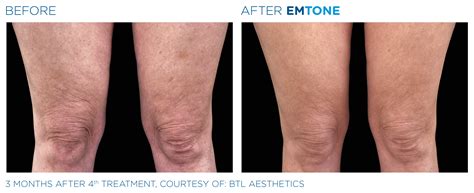 Before & After - The Body Haus