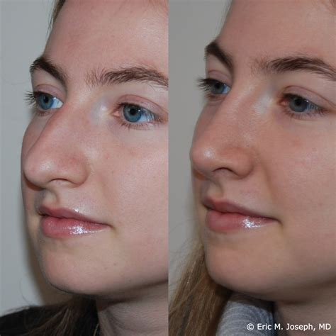eric  joseph md rhinoplasty   corrected