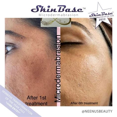 Microdermabrasion before and after – Artofit