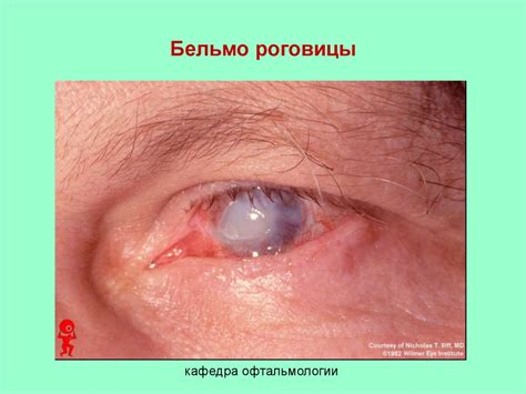 Заболевания роговицы. Лекция 4 - презентация онлайн