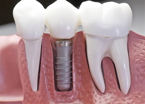 🦷Зубные импланты в Алматы - Имплантация зубов в рассрочку