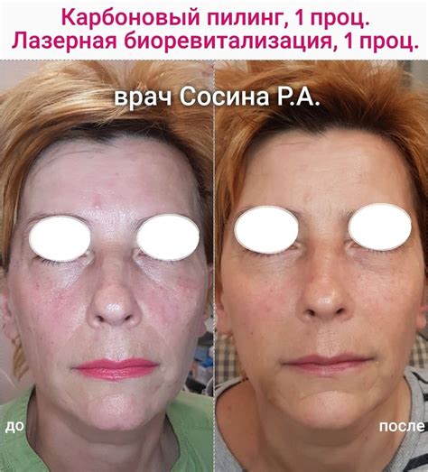 Карбоновый пилинг: отзывы, фото лица до и после