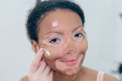 Opzelura: The New Vitiligo Treatment Authorized in Europe by EMA ...