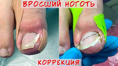 Вросший ноготь на большом пальце ноги / Ноготь после операции снова ...