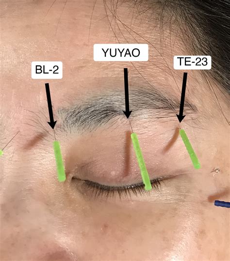 Treating Hooded Eyelids (Ptosis) - Facial Acupuncture Classes