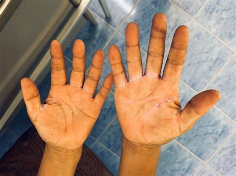 scleroderma specialist brisbane rheumatologycomau