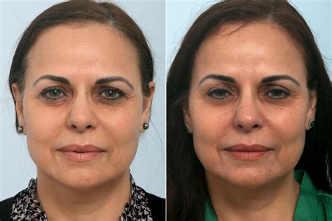 6 Ways To Achieve A Beautiful Jawline, Minus the Surgery | Houston, TX