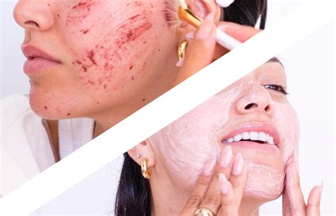 home remedy for face black spots 9
