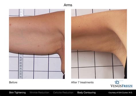 radio frequency skin tightening treatments  merrill lavallee blog