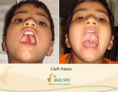 Offering Hope and Healing: Explore Comprehensive Cleft Lip and Palate ...