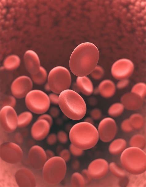Bard IVC Filter Lawsuit Blames Complications on Design Flaws - Top