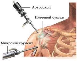 Синдром сужения плечевого сустава, импинджмент синдром плеча цена ...