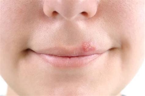 suffering  cold sore check  tips  cure  naturally